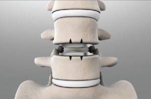 Spinal Disc Replacement