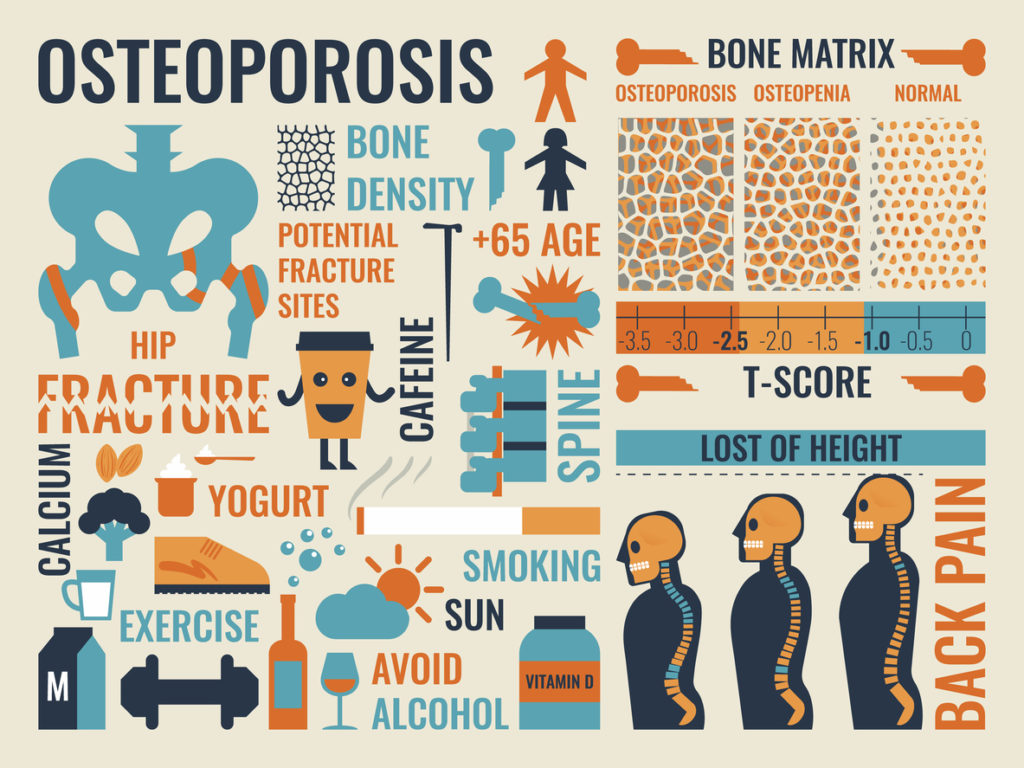 Illustration of osteoporosis infographic icon and elements concept