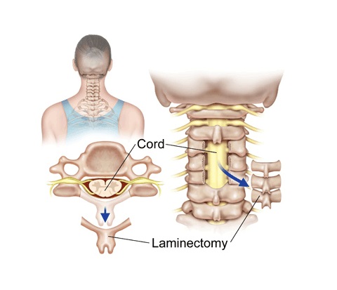 Laminectomy – Everything You Need to Know About It